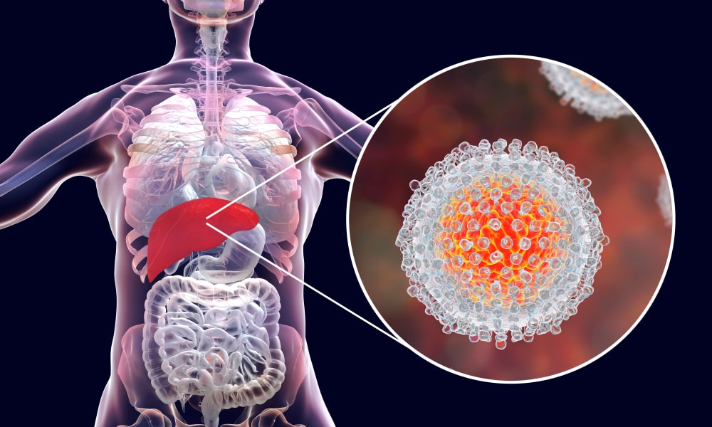 Norte e Nordeste apresentam crescimento alarmante nas mortes por hepatite crônica viral