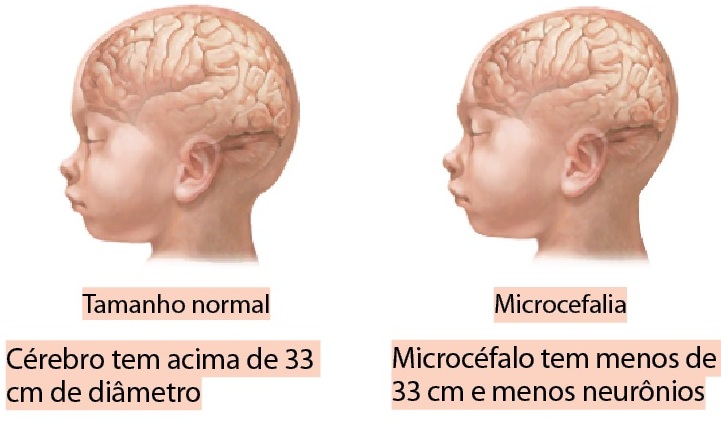 microcefalia