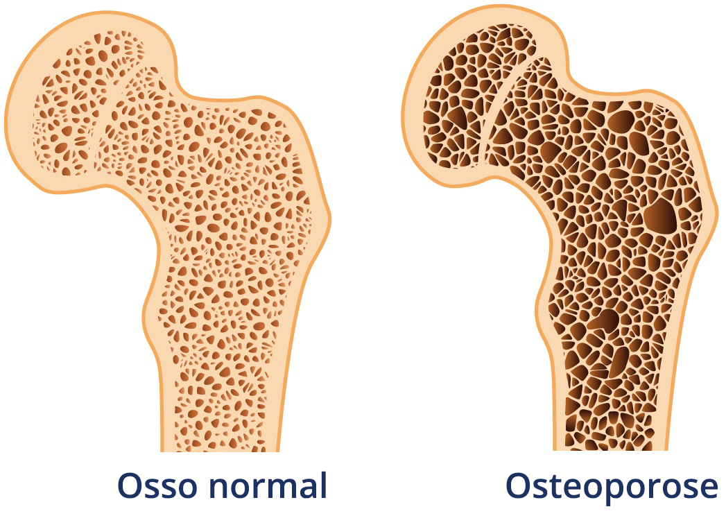 osteoporose 1