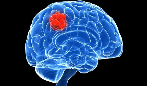 glioblastoma câncer no cérebro