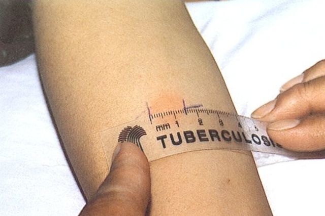 tuberculose