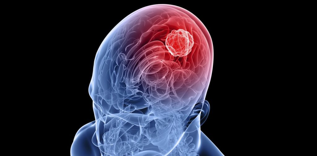 glioblastoma tumor cerebral