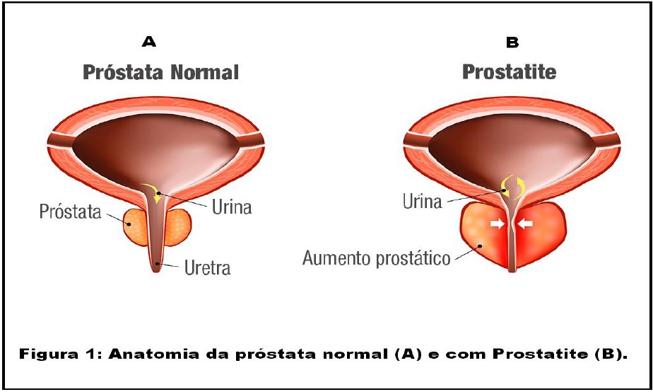 prostatite aguda