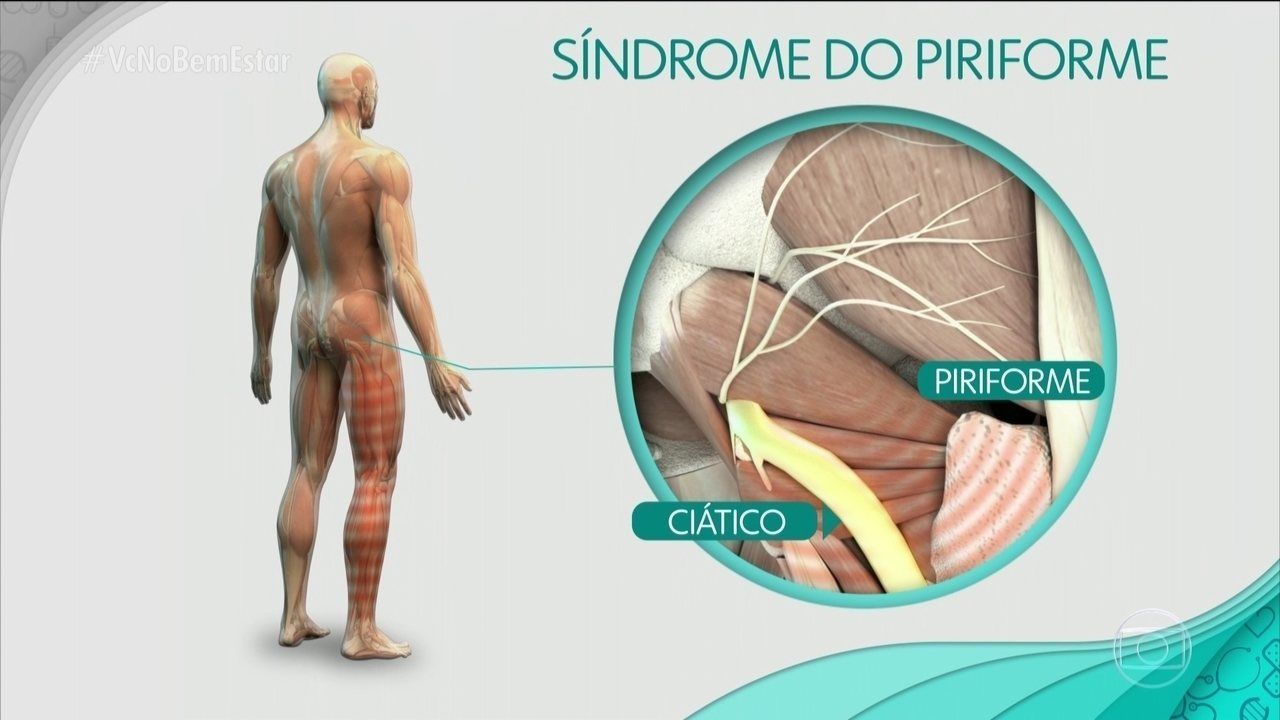 Síndrome do piriforme o que é causas e como tratar