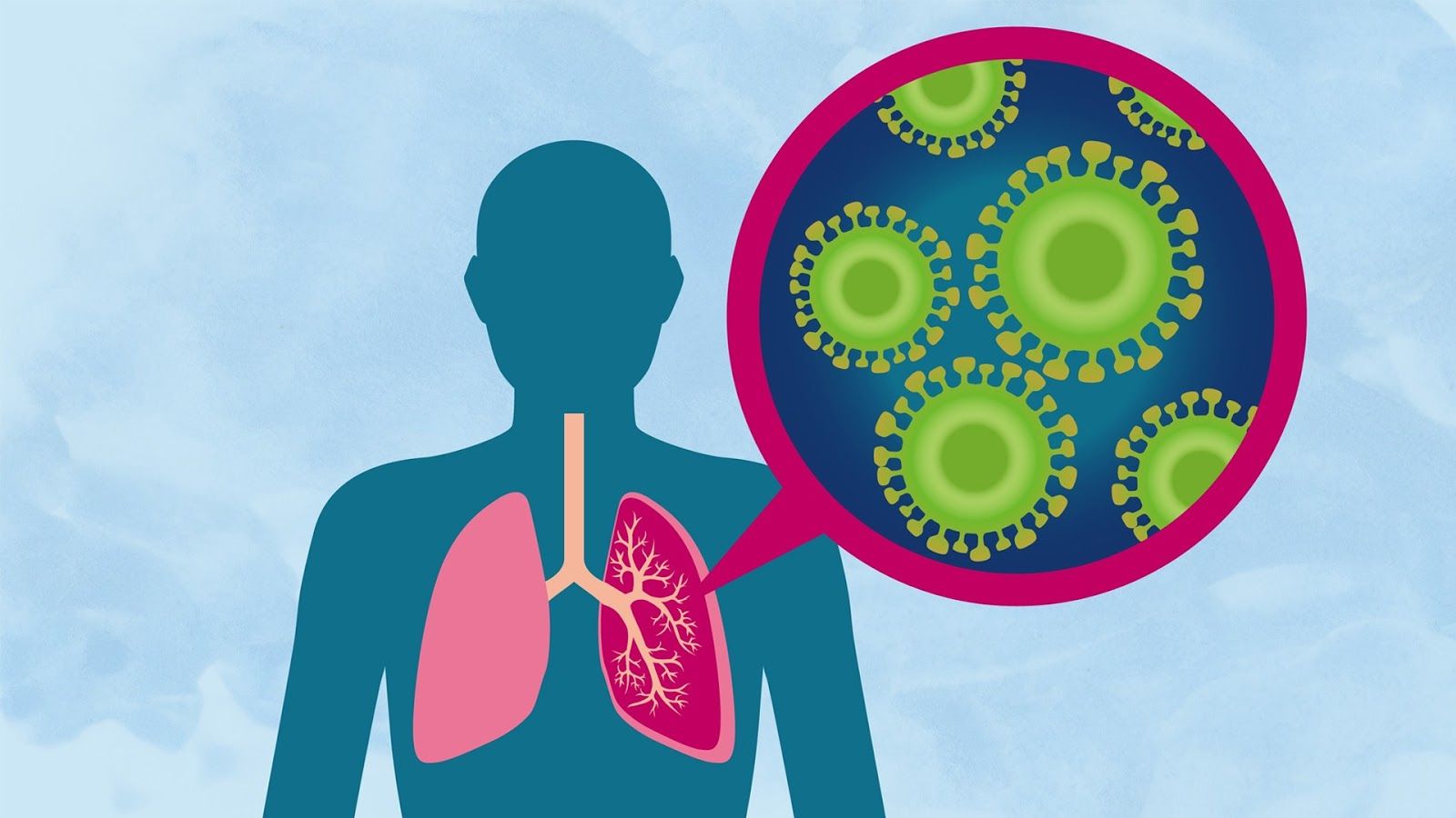 Coronavírus é preocupação do momento mas pneumonia mata 7 pessoas por hora no Brasil