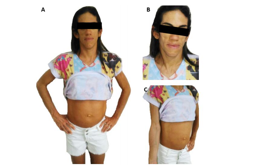 Síndrome de Berardinelli no rn serido potiguar sindrome rara