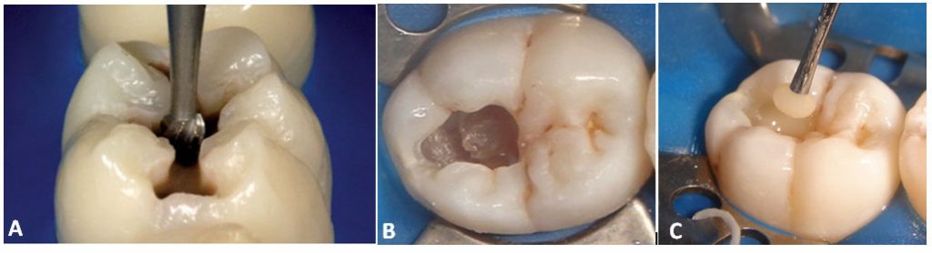 Tratamento de cárie sem dor 