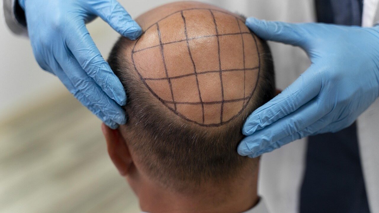 Surprise Hair Loss Breakthrough: A Sugar Gel Triggers Robust Regrowth