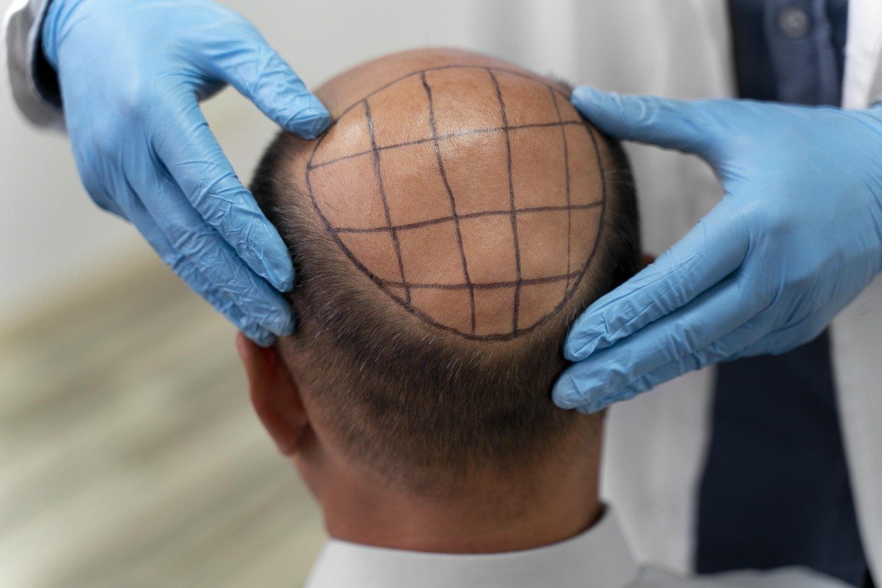 Surprise Hair Loss Breakthrough: A Sugar Gel Triggers Robust Regrowth